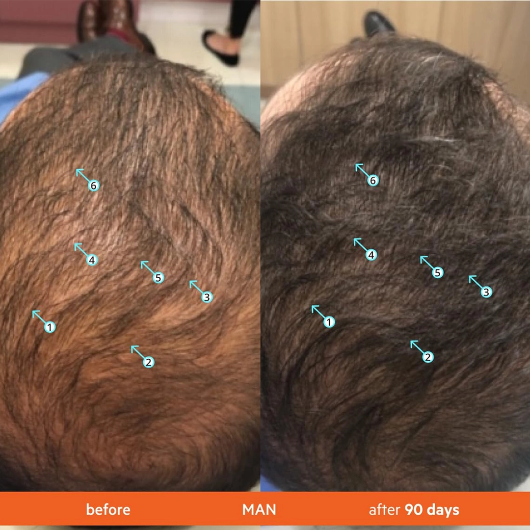 LOCIÓN CAPILAR AMD HAIR (2 ampollas de 15 ml cada una)