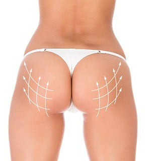 Gluteal Butt Lift (BBL)