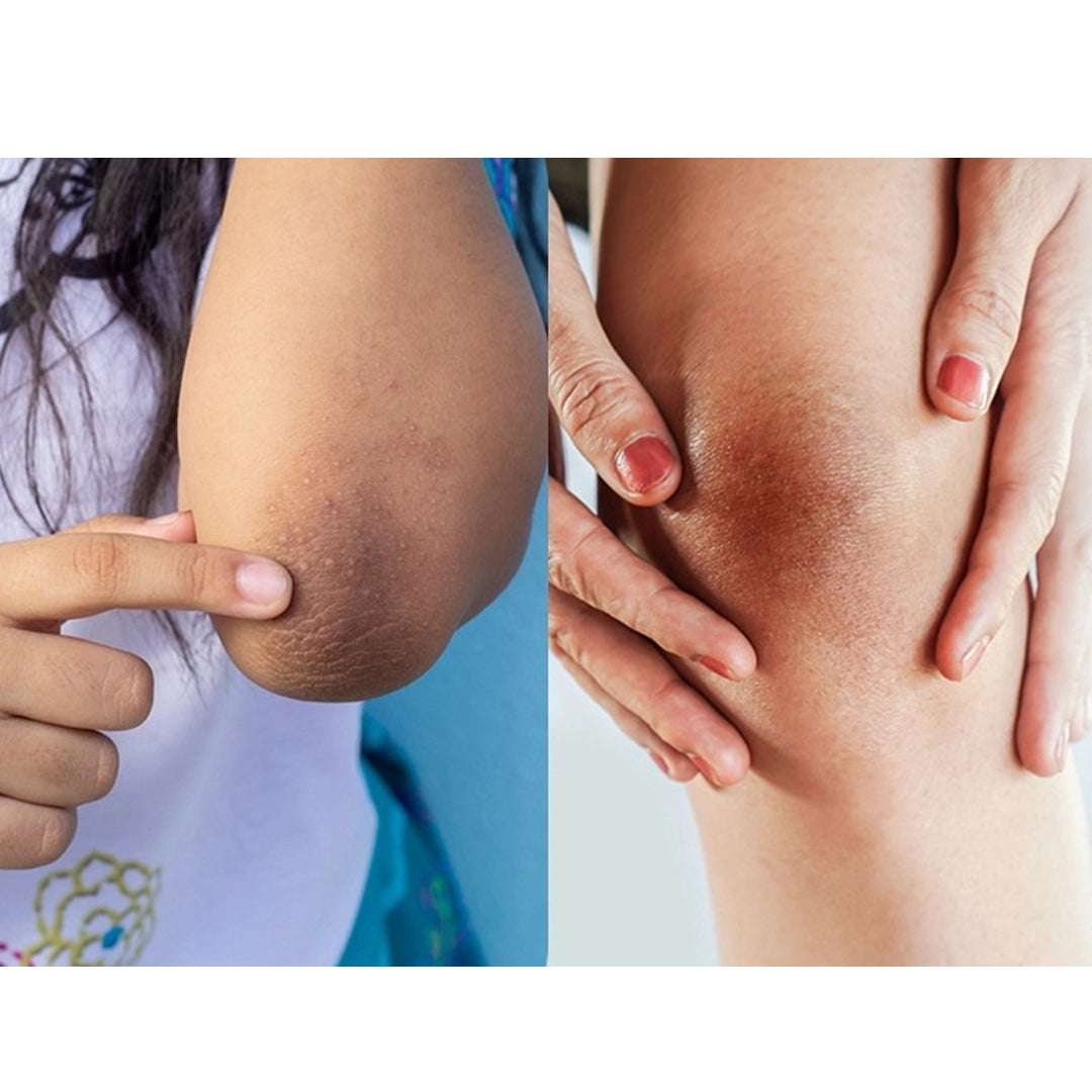 Knees & Elbows Dark Spot Corrector Cream 1.7 oz