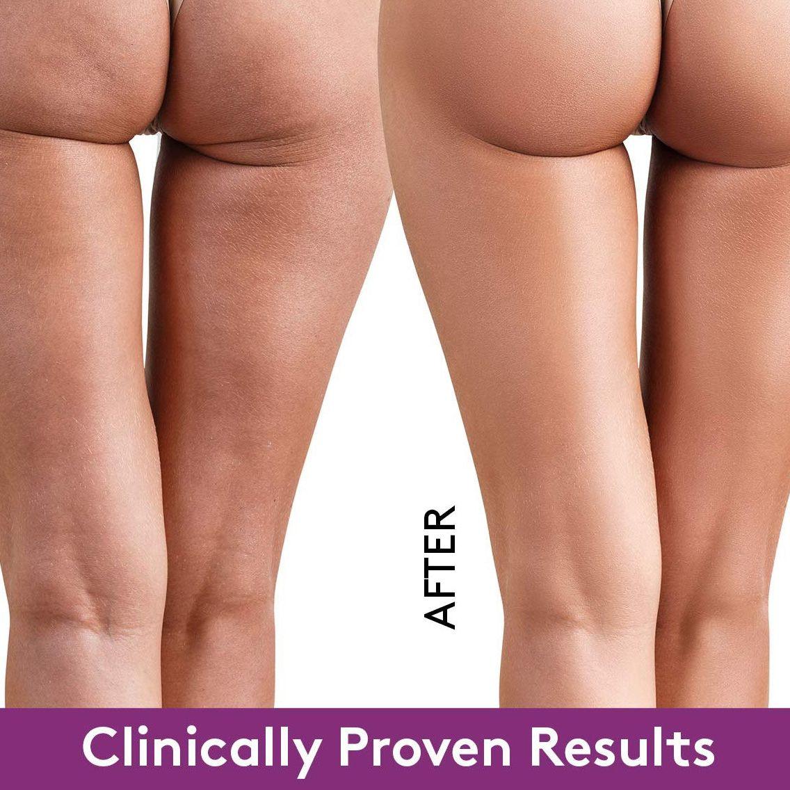 BBL Booty Protocol Vials wholesale — professional non-invasive buttock enhancement mesotherapy for licensed spas | SlimSpa