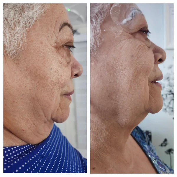 EnzyDermik 5 vials of 10ml (50ml) - SlimSpaOnline