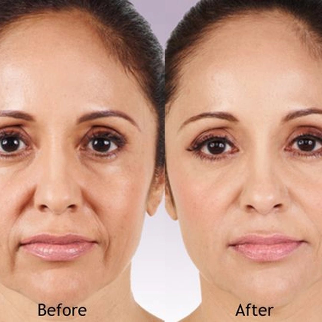 HYALURONIC ACID PLUS 1% (10 Ampoules x 2 ml ea.) - SlimSpaOnline