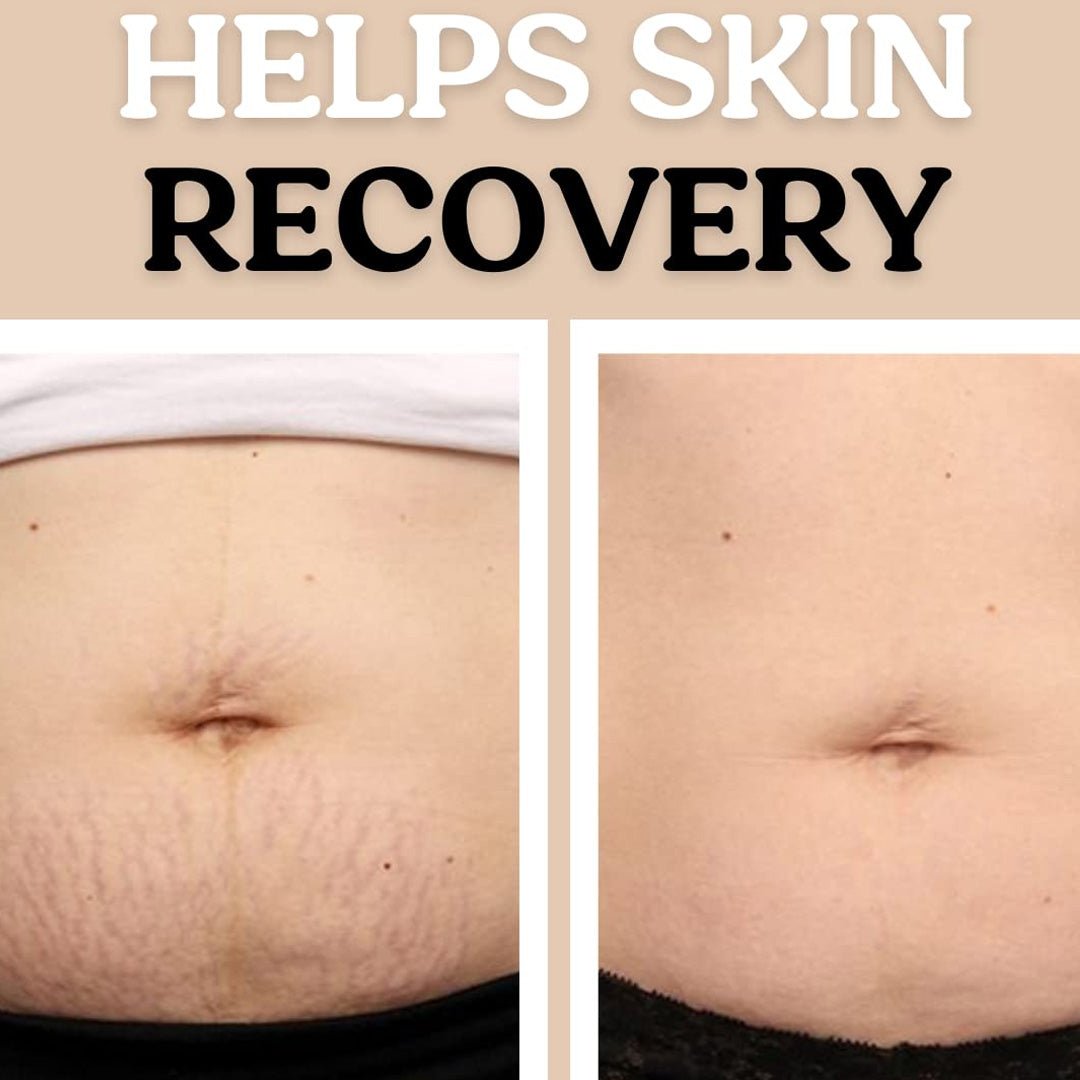 Stretch Mark Prevent & Repair Duo - SlimSpaOnline
