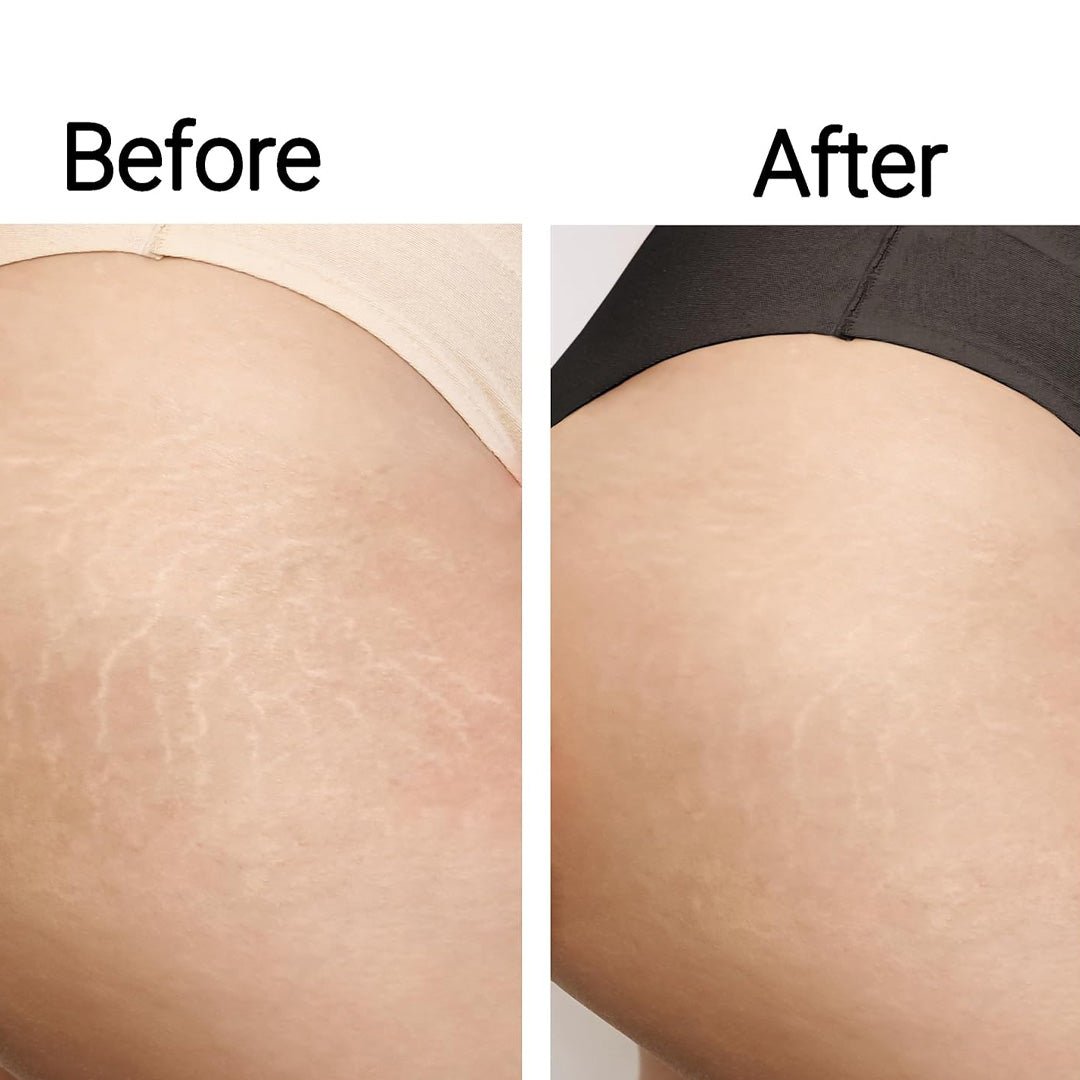 StriaeSolution Serum 8 oz. - SlimSpaOnline